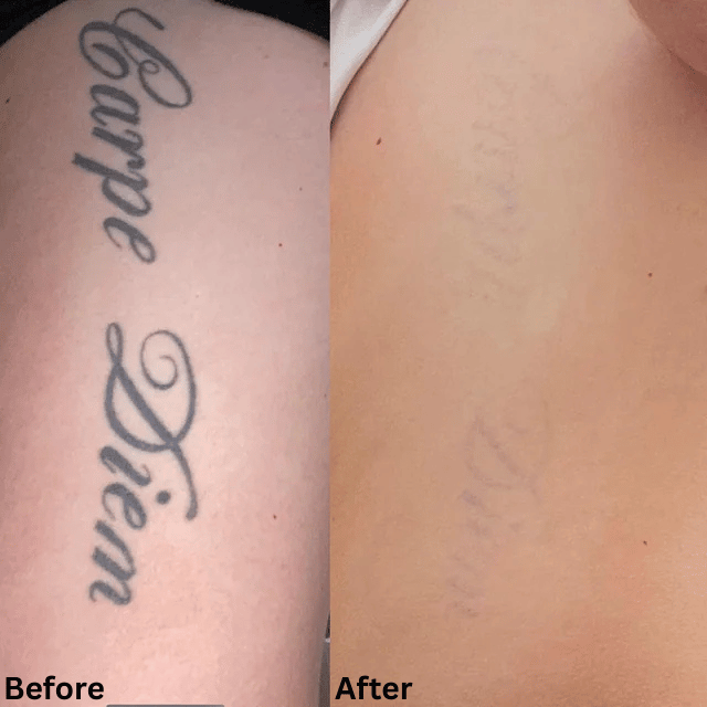 Laser Tattoo Removal before after result