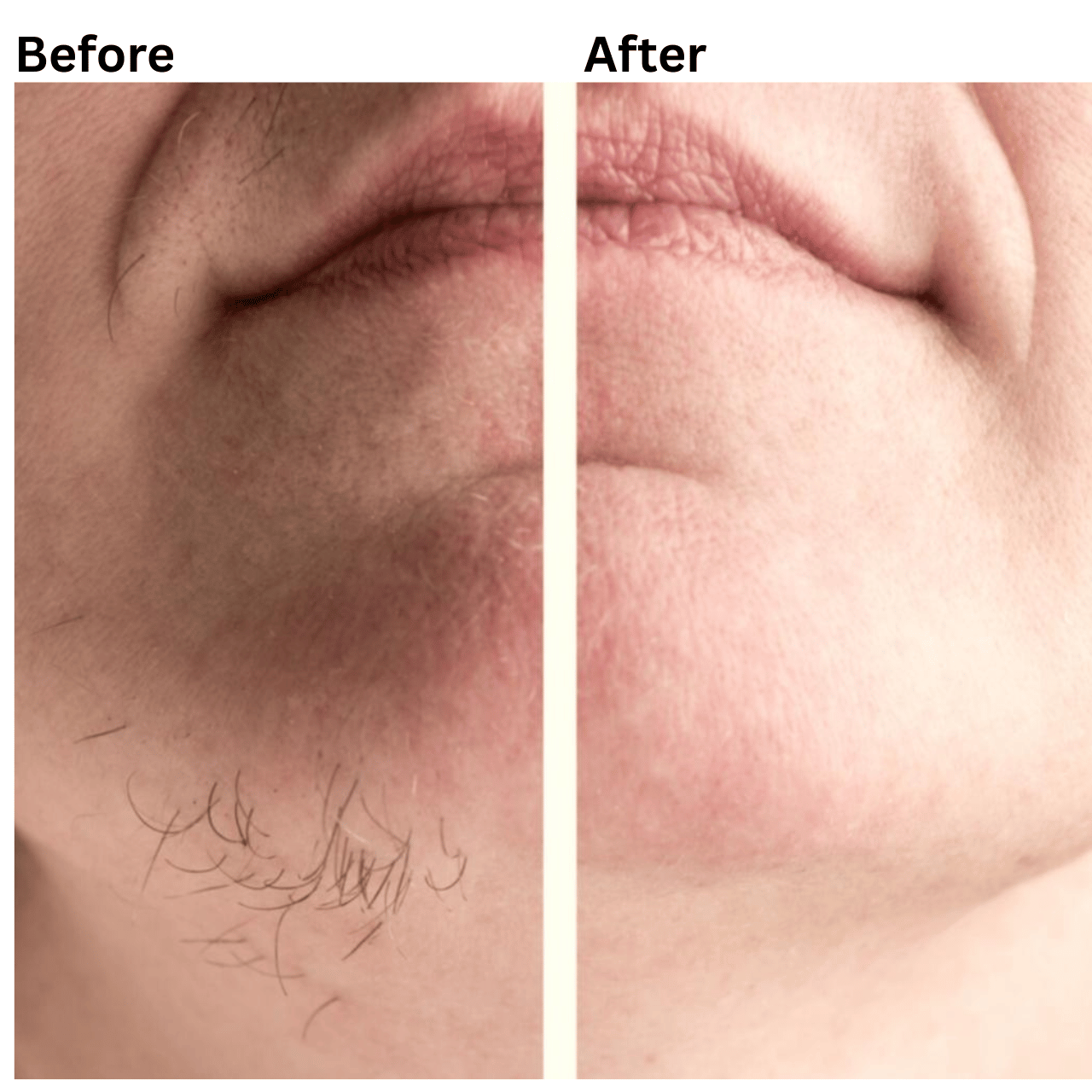 IPL removal treatment
