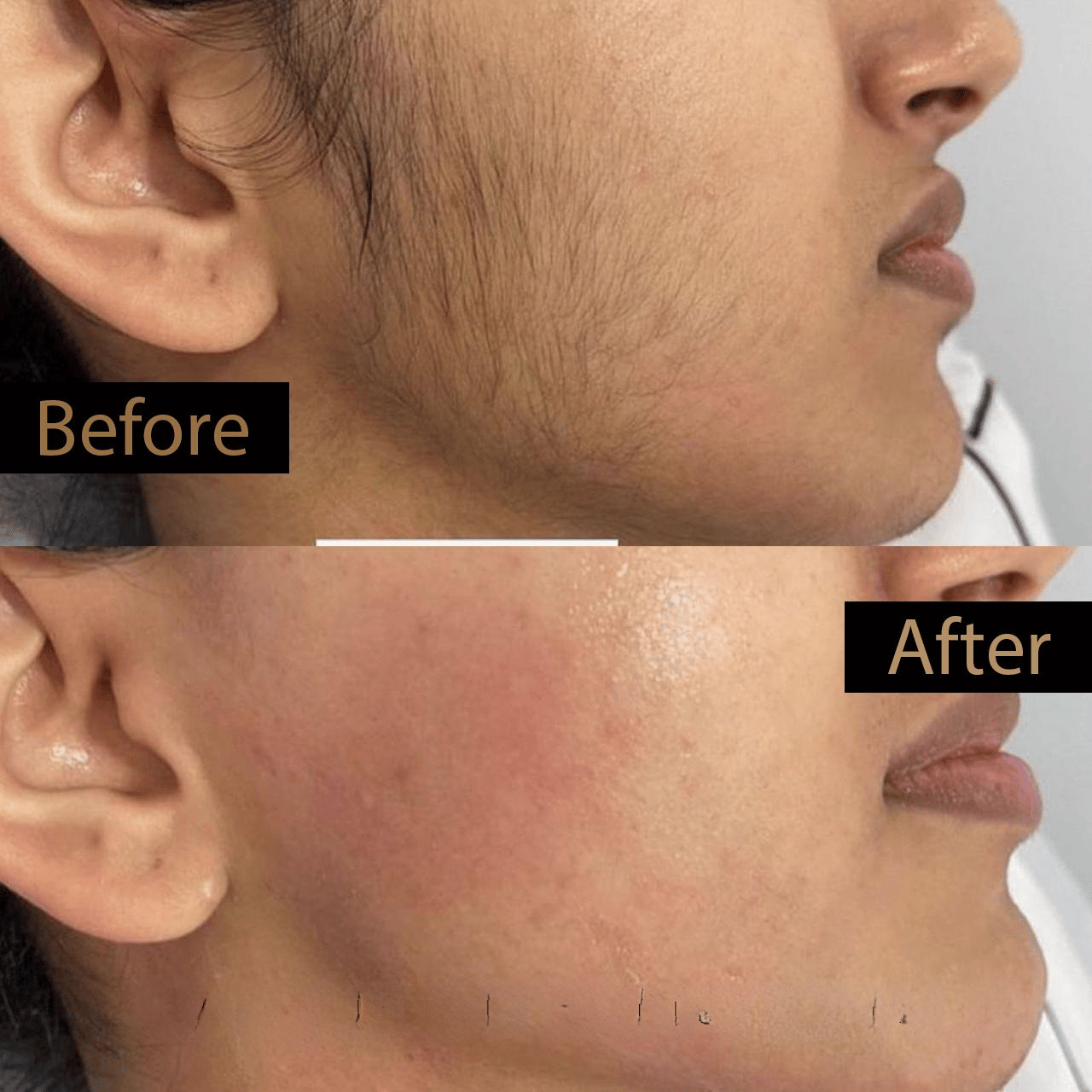 Laser hair removal