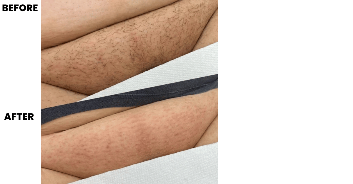 Bikini hair removal before after result
