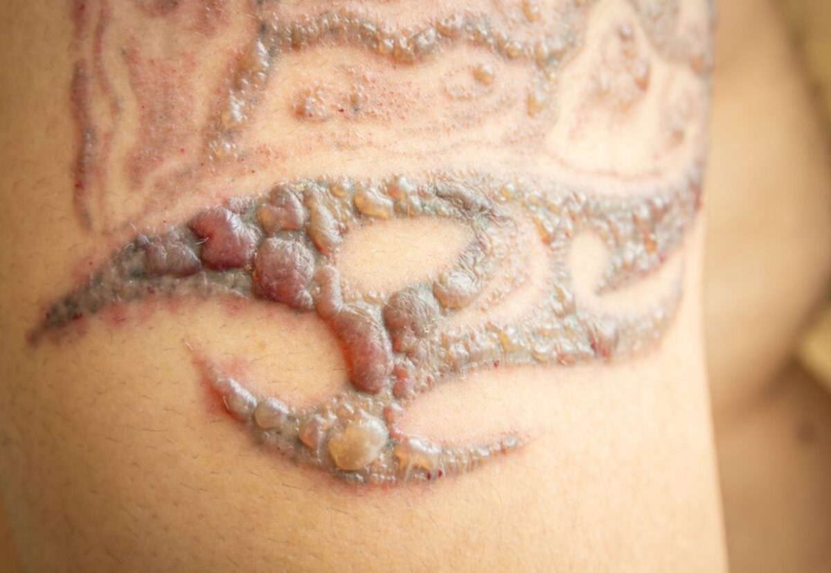 Skin Take time to Heal after laser tatoo removal
