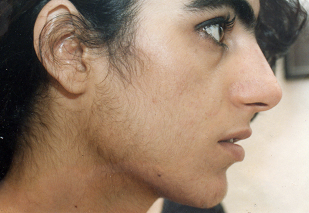 Hypertrichosis