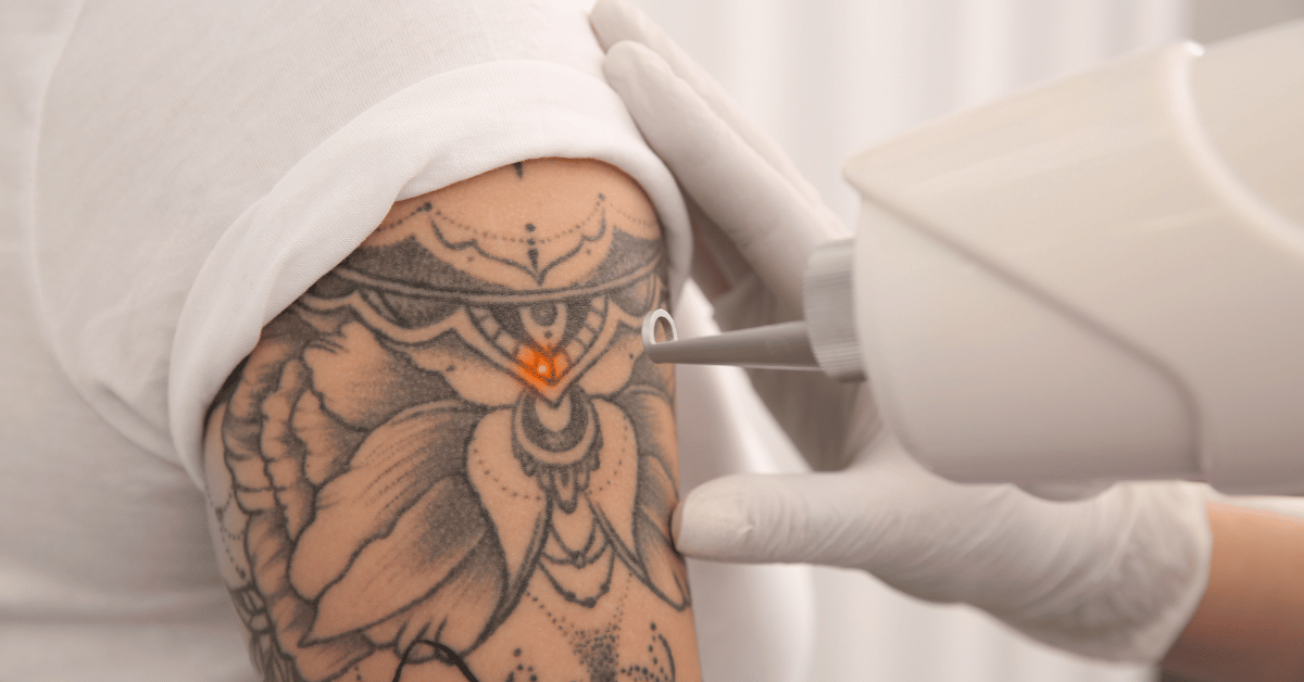 Laser Tattoo Removal treatment by Mumbai Cosmetic Centre