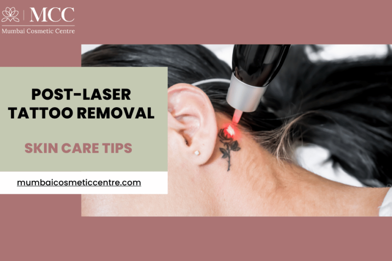 Post-Laser Tattoo Removal: Essential Skin Care Tips