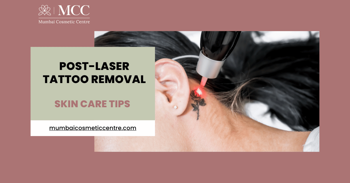Post-Laser Tattoo Removal: Essential Skin Care Tips