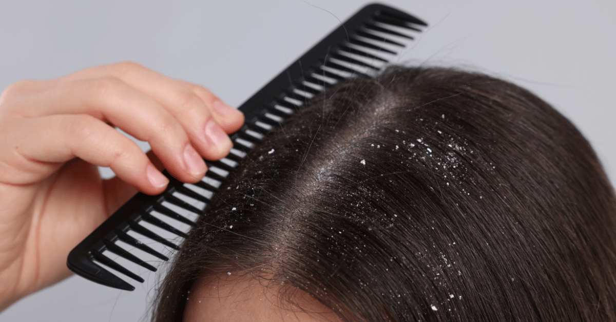 Causes of Dandruff