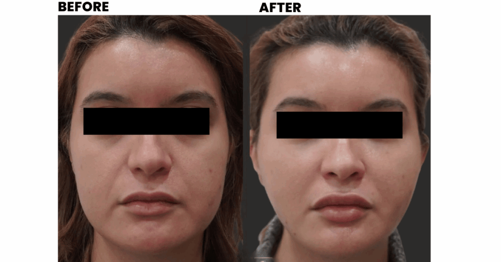 Trending Uses of Dermal Fillers in 2025