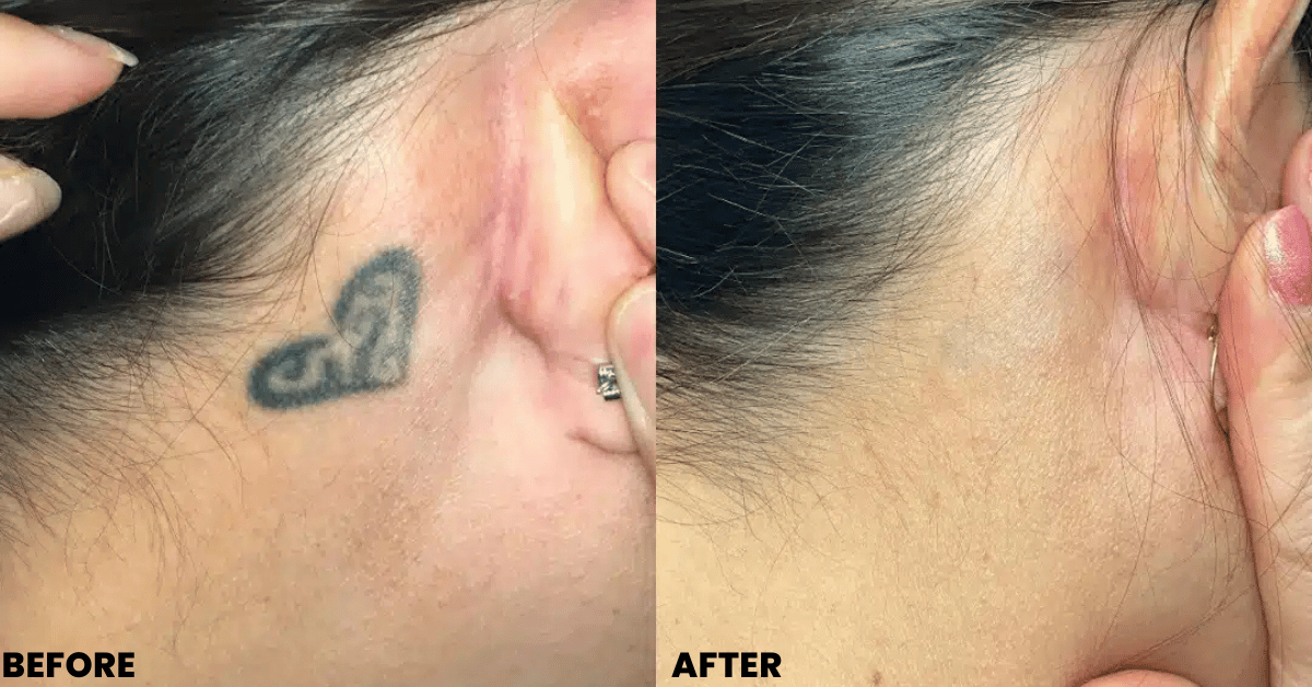 Laser Tattoo Removal in Mumbai