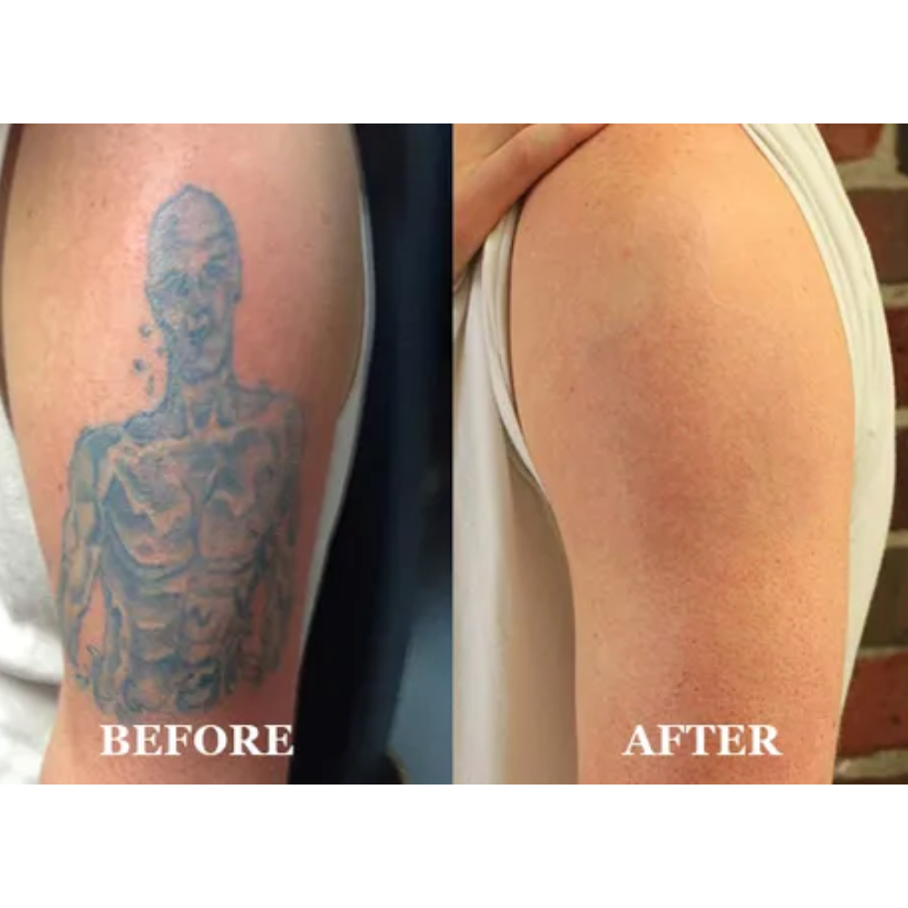 Benefits of Choosing Laser for Tattoo Removal