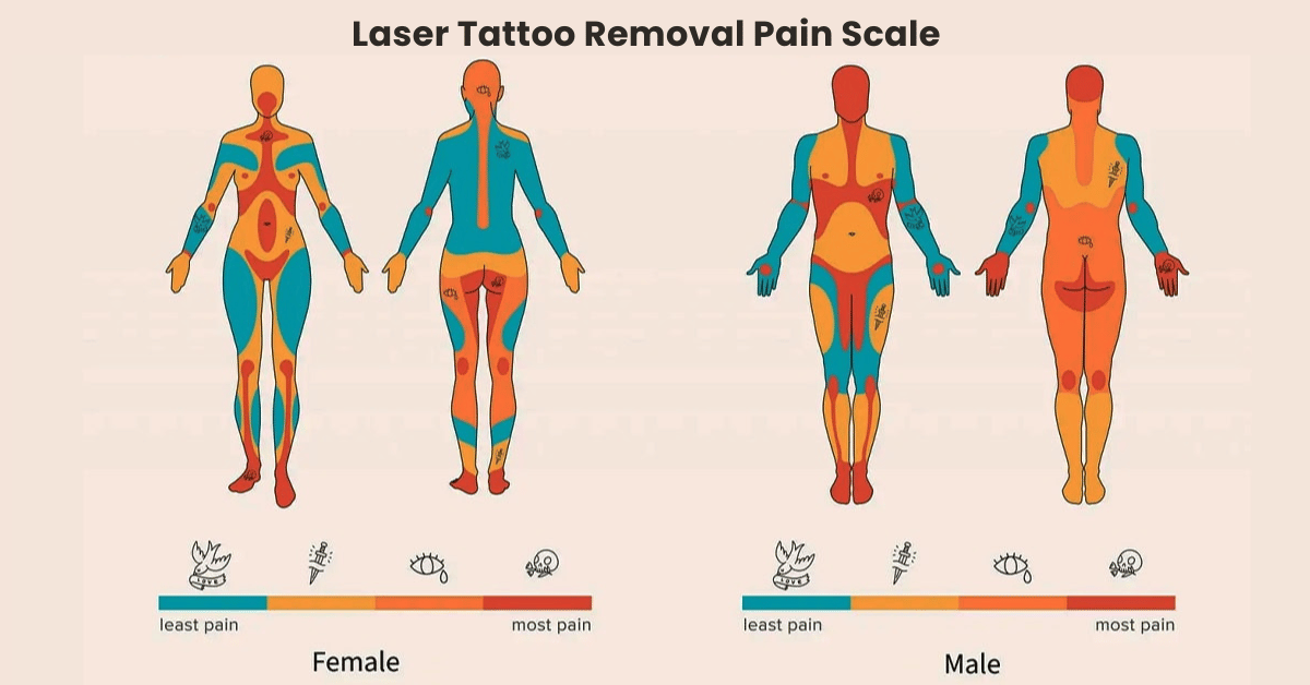 Laser Tattoo Removal Pain Scale