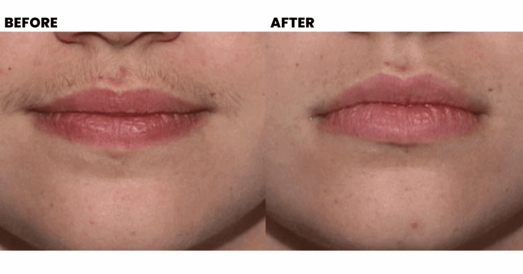 Upper Lip Laser Hair Removal before after result