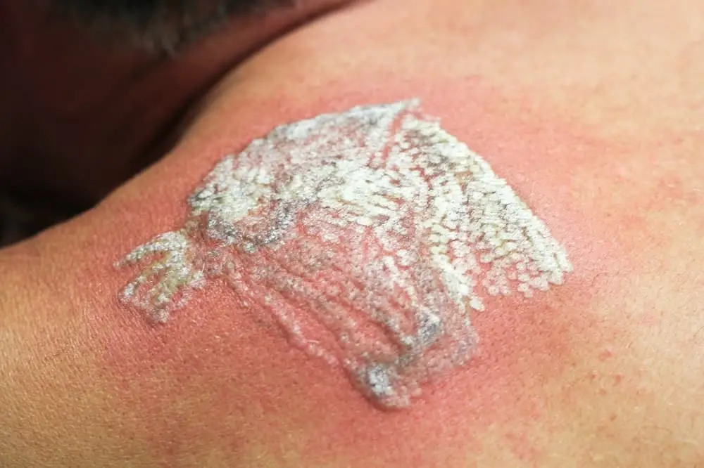 Laser Tattoo Removal aftercare