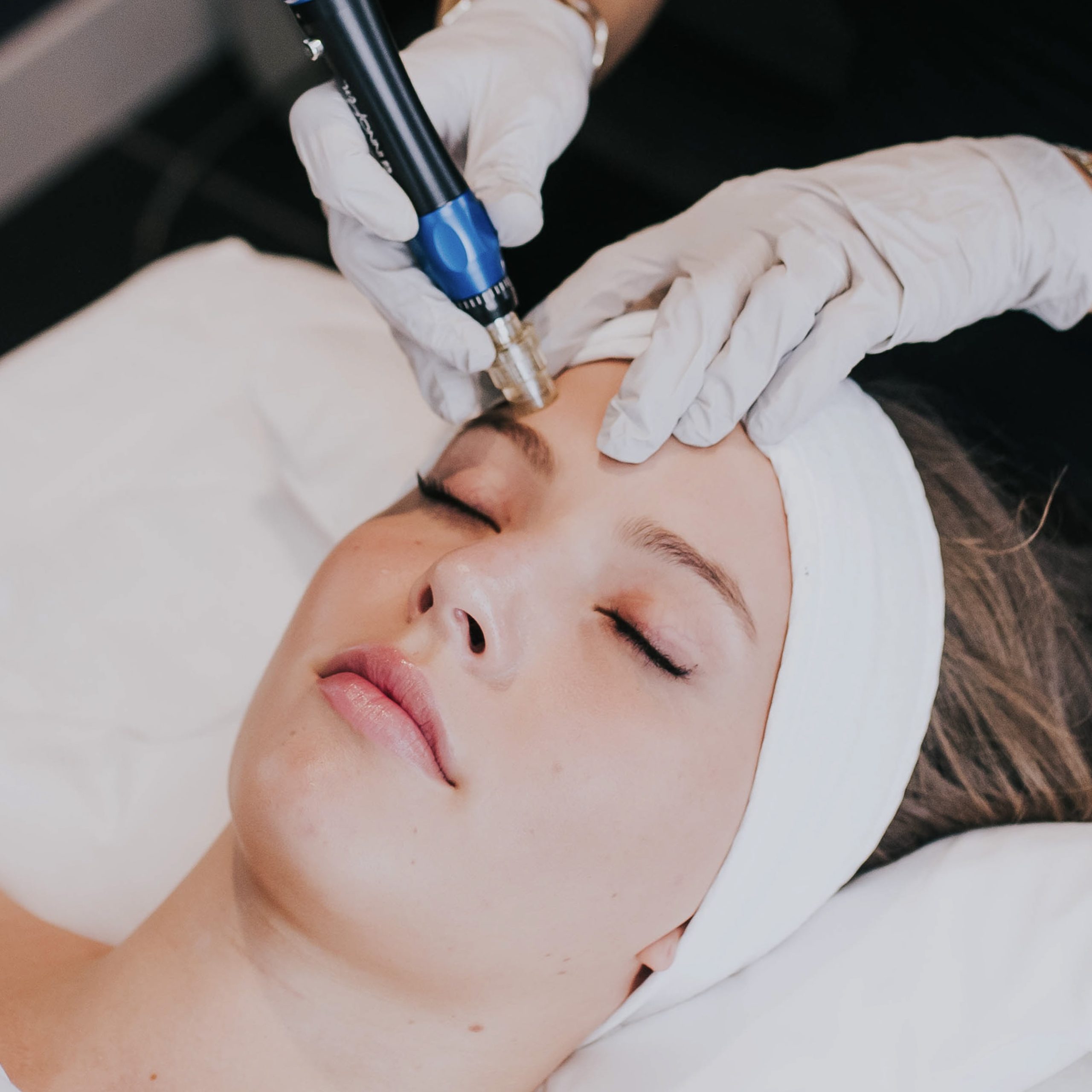 What is Next-Gen Microneedling?