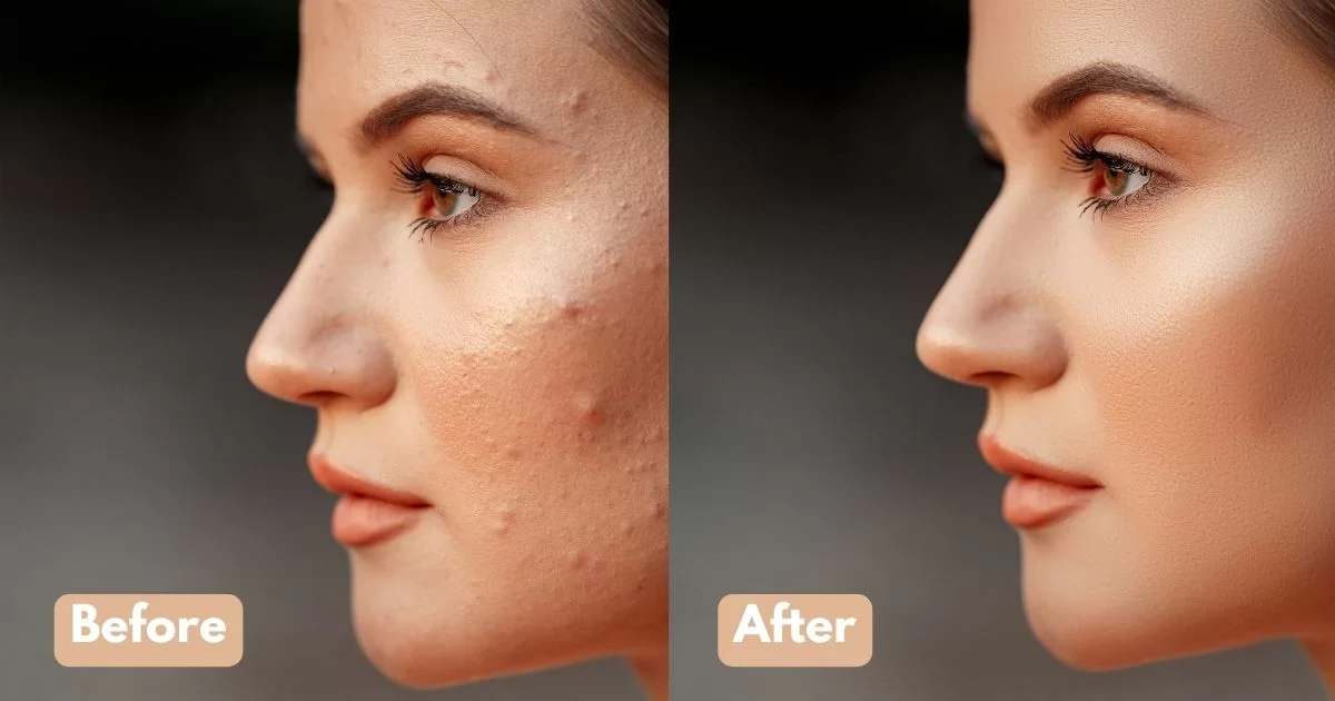 How Skin Boosters Work and What to Expect