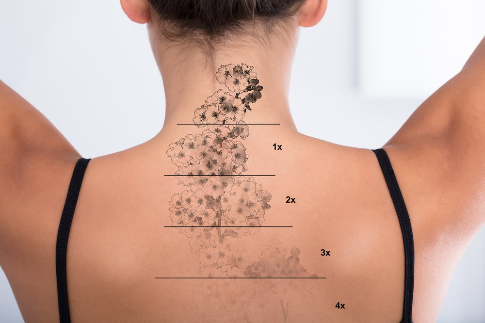 Tips and Recommendations for tatoo removal
