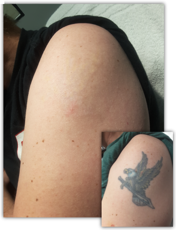 Understanding Tattoo Removal