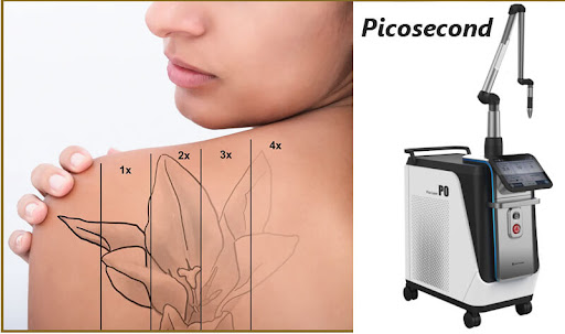 What Is a Picosecond Laser?