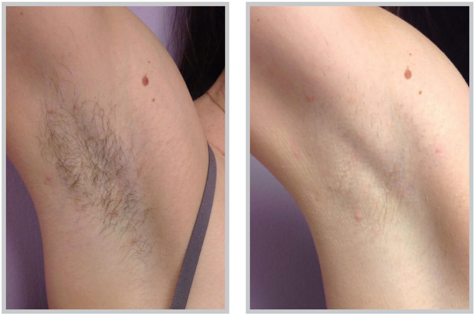 What is Laser Hair Removal?