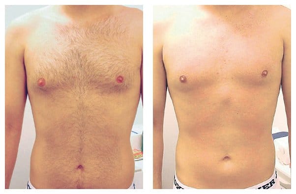 Male Laser Hair Removal in mumbai cosmetic centre