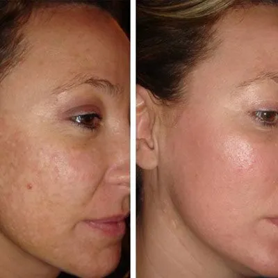 Benefits of Laser Treatment for Melasma