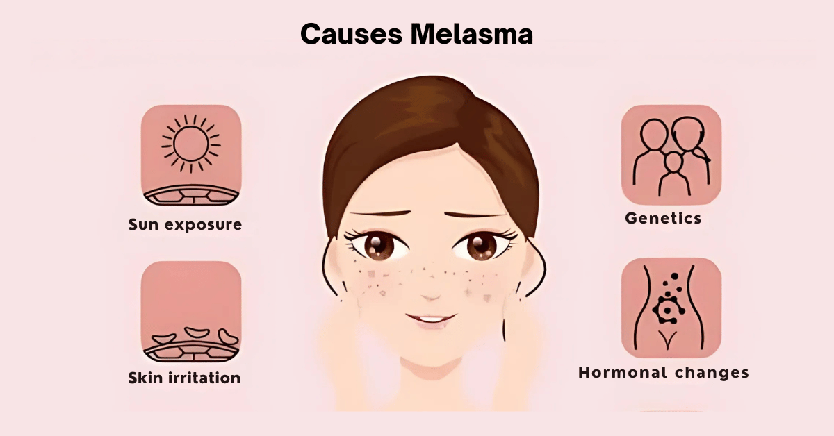 Learn Causes of melasma at Mumbai Cosmetic centre