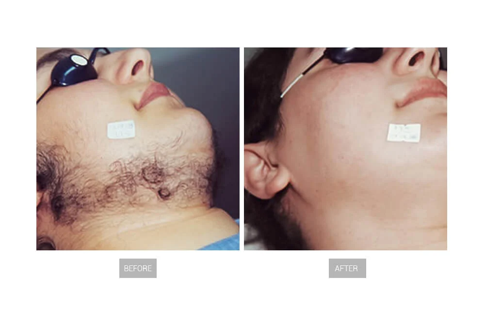 How Does Electrolysis Work? Learn in Mumbai at Mumbai Cosmetic Centre