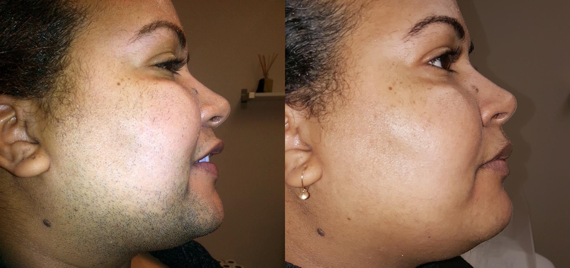 laser hair removal before after result