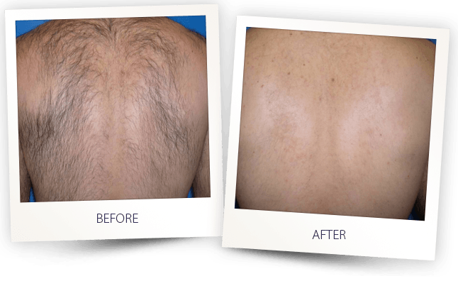 Laser Hair Removal before after result