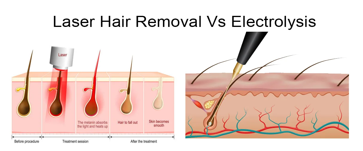 Laser hair removal or electrolysis in Mumbai at Mumbai Cosmetic Centre