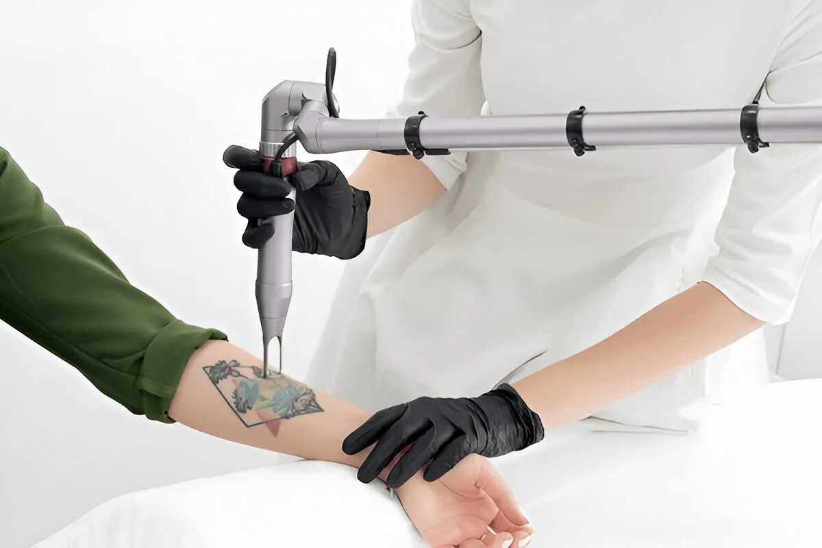 Laser Tattoo Removal at Mumbai Cosmetic centre