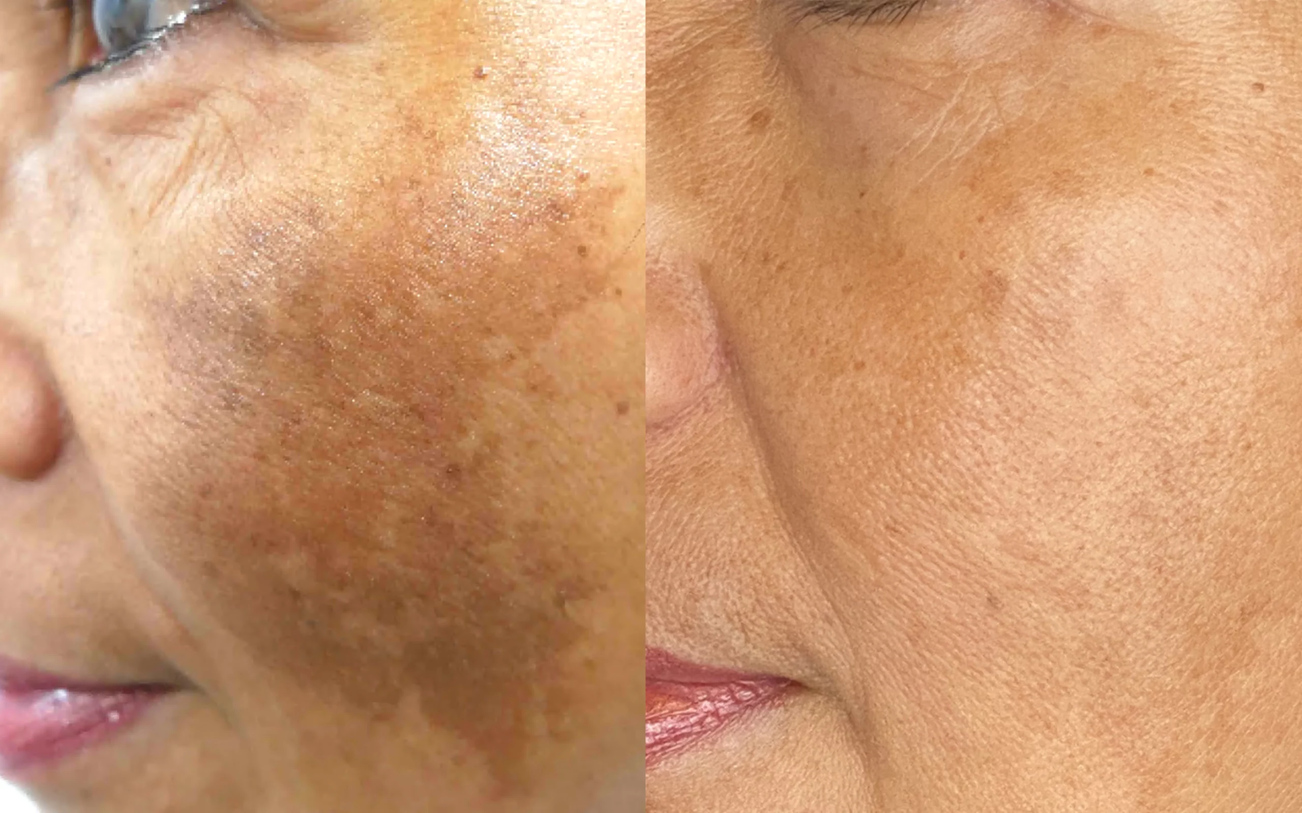 What is Melasma?