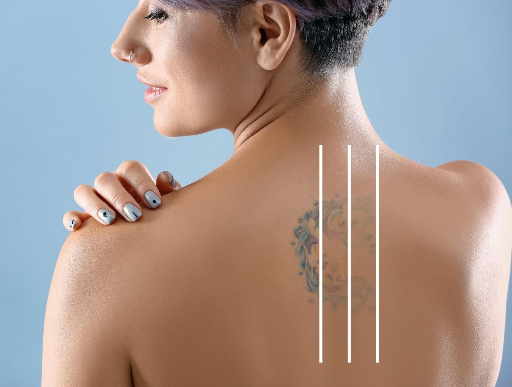 laser tatoo removal aftercare