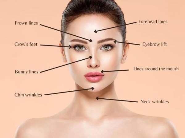 Common treatment areas for Botox treatment