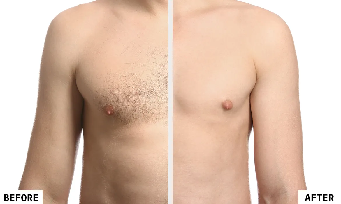 What is Full Body Laser Hair Removal?