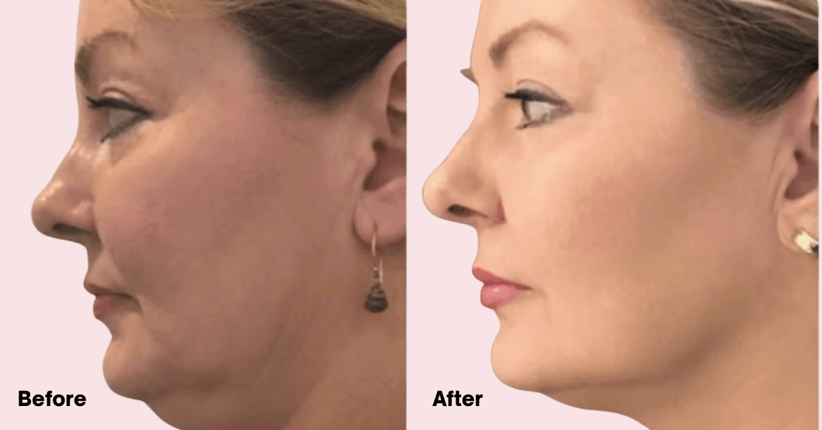 How Does HIFU Work? learn at Mumbai Cosmetic Centre