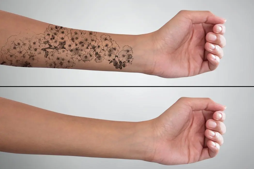 What to Expect: Before, During, and After laser tatoo removal