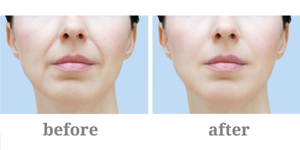What Is Botox and How Does It Work?