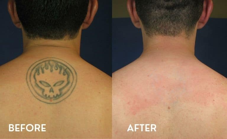 Laser Tattoo Removal: How Many Sessions Will You Need?