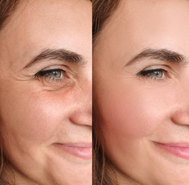 Who Is an Ideal Candidate for Botox?