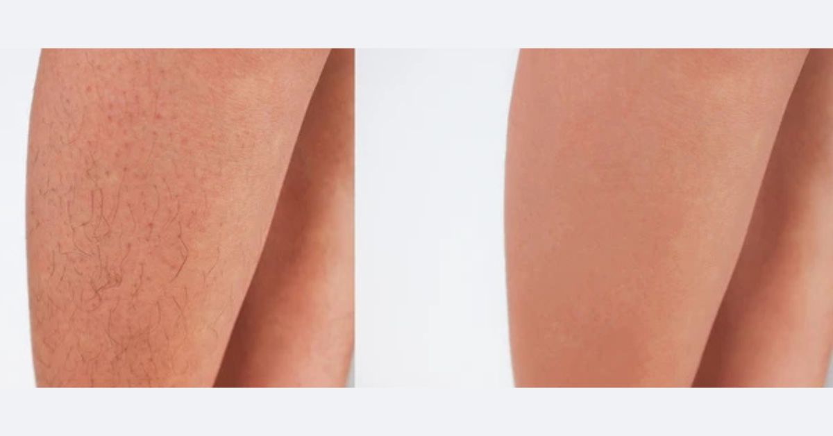 What to Expect During the laser haie Treatment