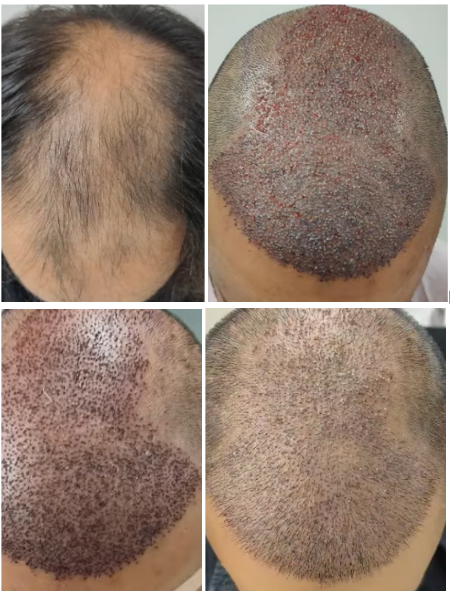 Why Aftercare is Crucial for Hair Transplant Success