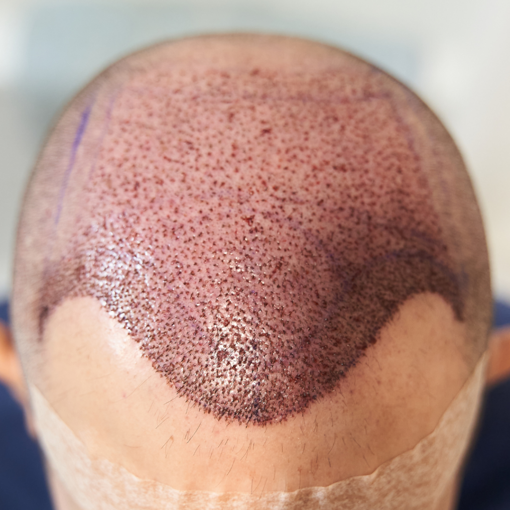 Pain Management After Hair Transplant