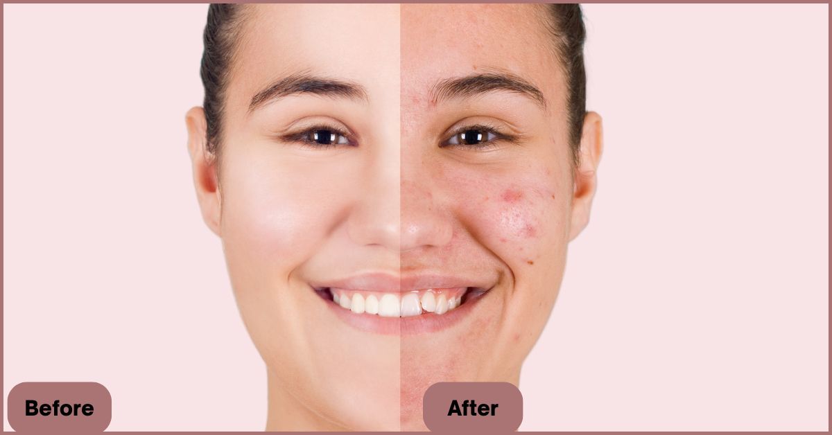 Is HydraFacial Worth the Cost?