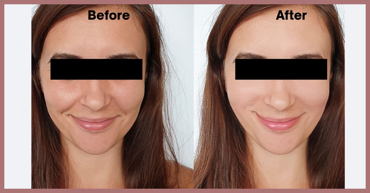 HydraFacial Treatment In Mumbai at Mumbai Cosmetic centre