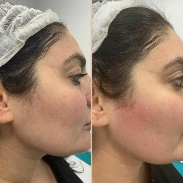 Laser Hair Removal Before after result