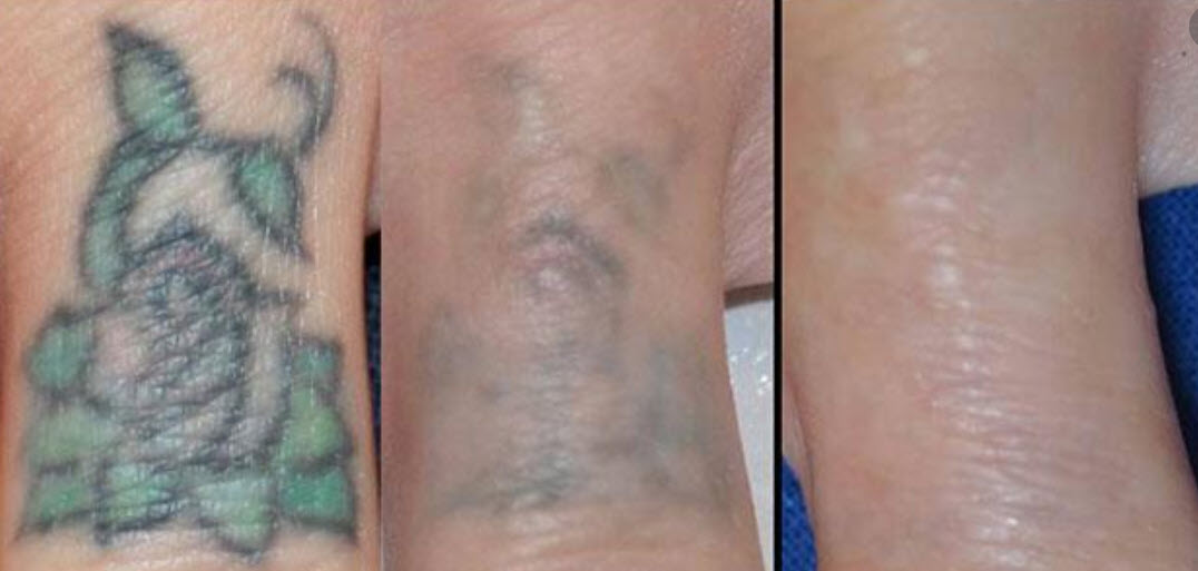 Laser Tattoo Removal: Possible Side Effects and Risks