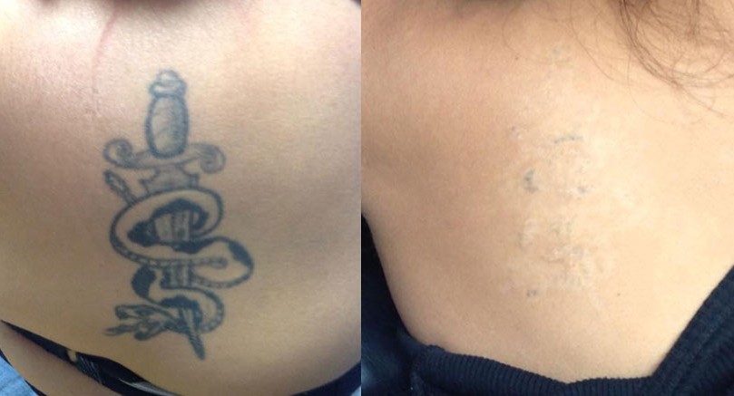 What Is Laser Tattoo Removal?