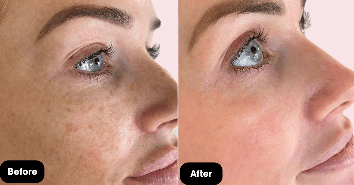 What is Chemical Peeling? leran at mumbai Cosmetic Centre, Mumbai