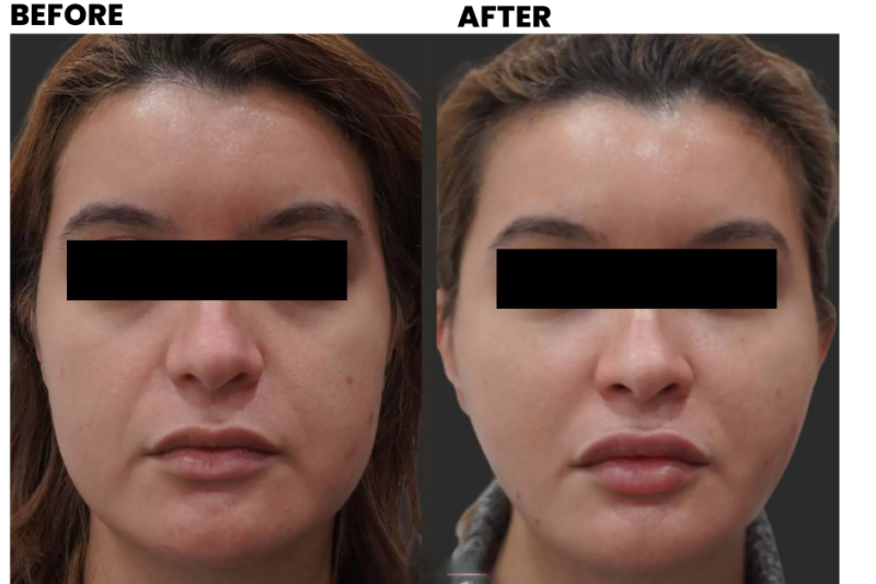 Dermal Fillers Treatment In Mumbai: Price, Procedure, & Benefits