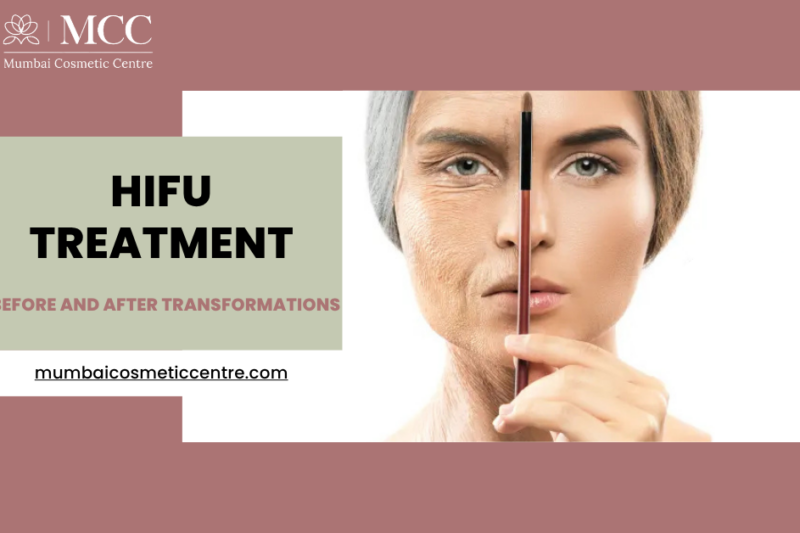 hifutreatmentbeforeandaftertransformationsinmumbai
